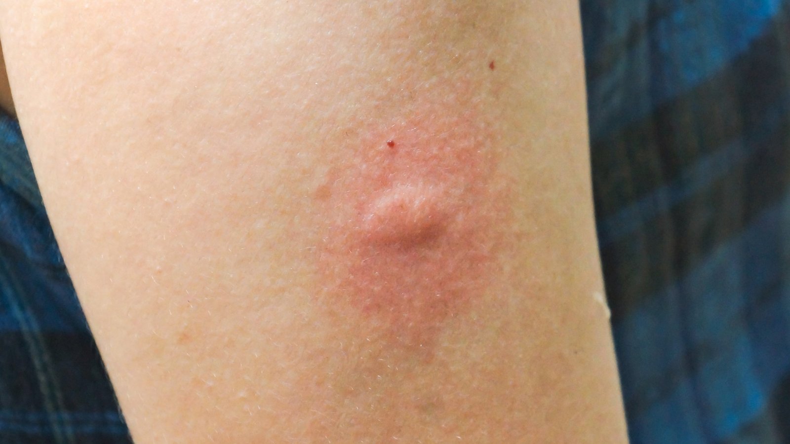 Close-up-of-mosquito-bite
