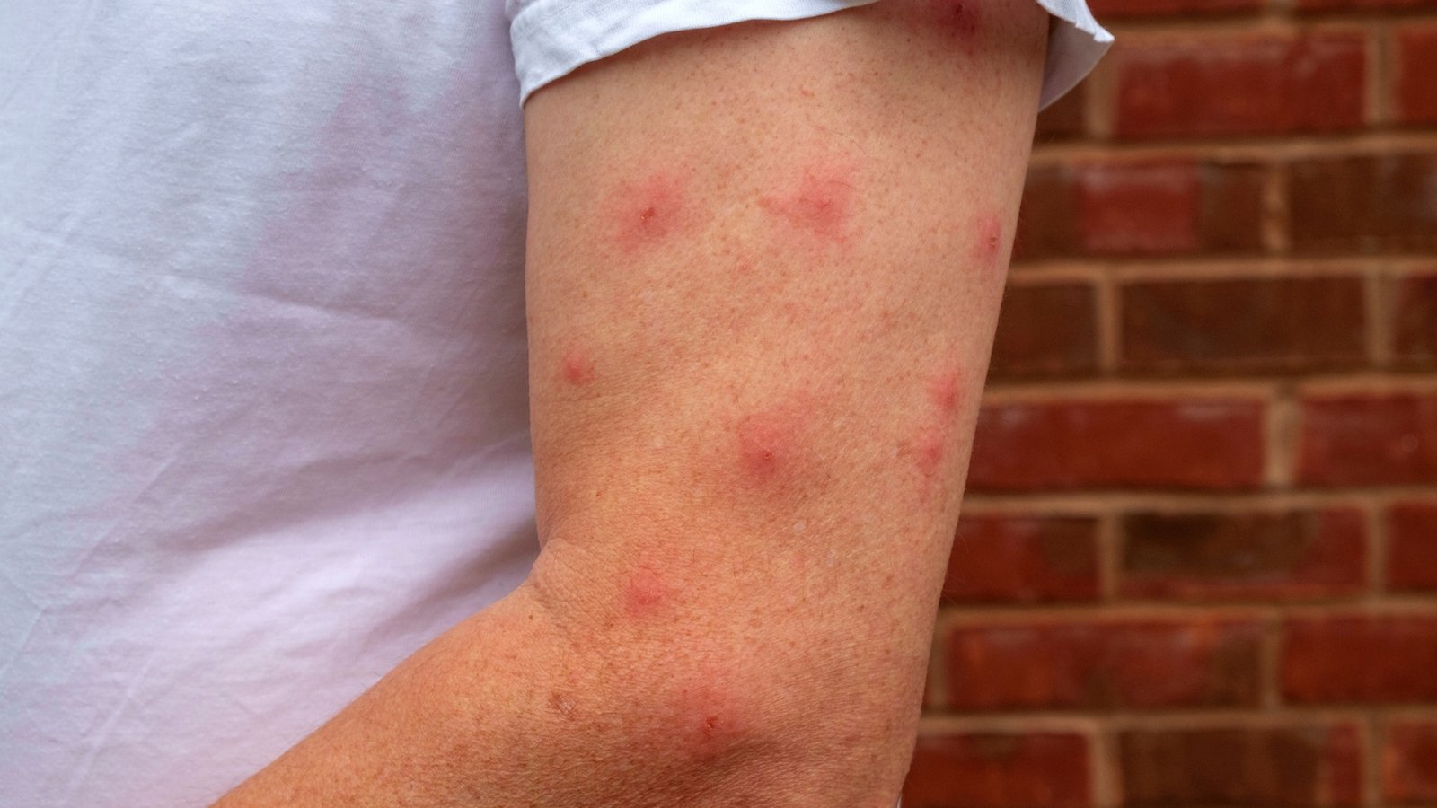 Person-s-arm-up-close-with-multiple-mosquito-bites